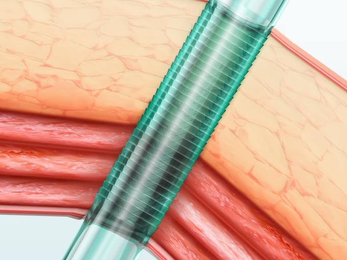 Cannula van Trocar van Laparoscopicinstrumenten Beschikbare met Blad 0