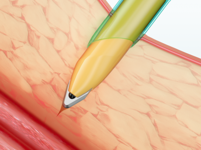 Cannula van Trocar van Laparoscopicinstrumenten Beschikbare met Blad 1